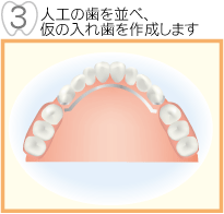 人工歯を並べ、仮の入れ歯を作成します