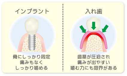 インプラントと入れ歯の違い